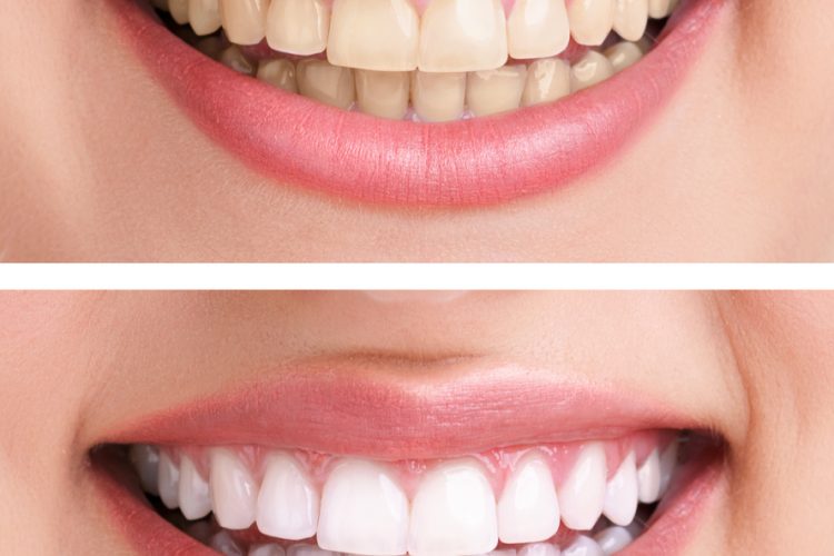 teeth whitening 1